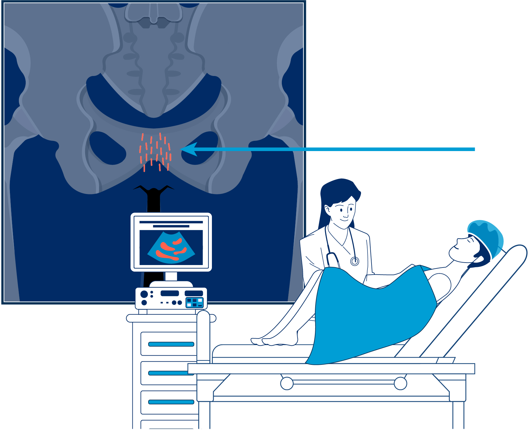 Semillas radioactivas braquiterapia